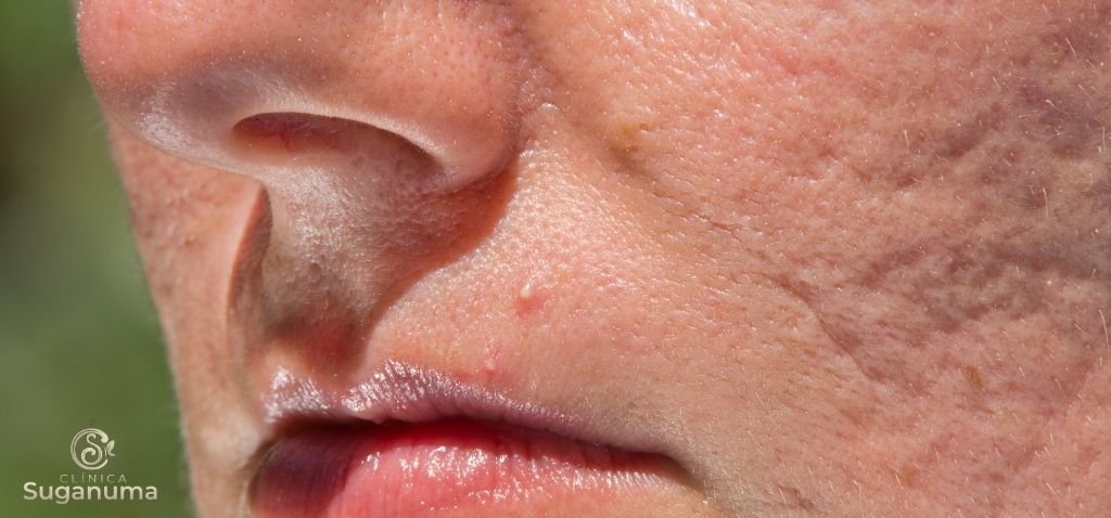 Ha-algum-tratamento-nao-invasivo-disponivel-que-possa-ser-eficaz-na-melhoria-das-cicatrizes-de-acne