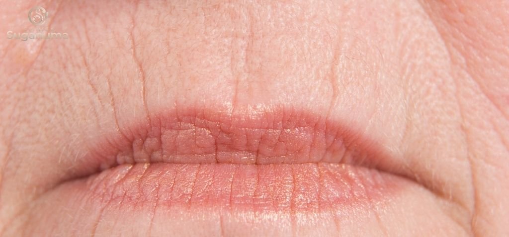 O-que-pode-causar-as-rugas-ao-redor-do-labio-ou-codigo-de-barra-e-como-preveni-las