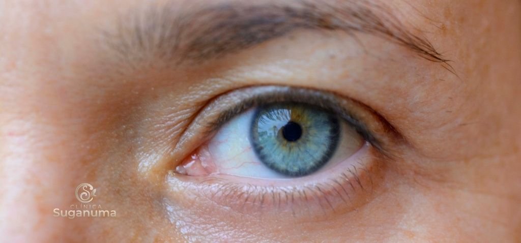 O-que-pode-causar-flacidez-de-palpebras-e-como-preveni-la