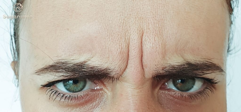 Como-tratar-as-rugas-do-bravo-de-forma-eficaz