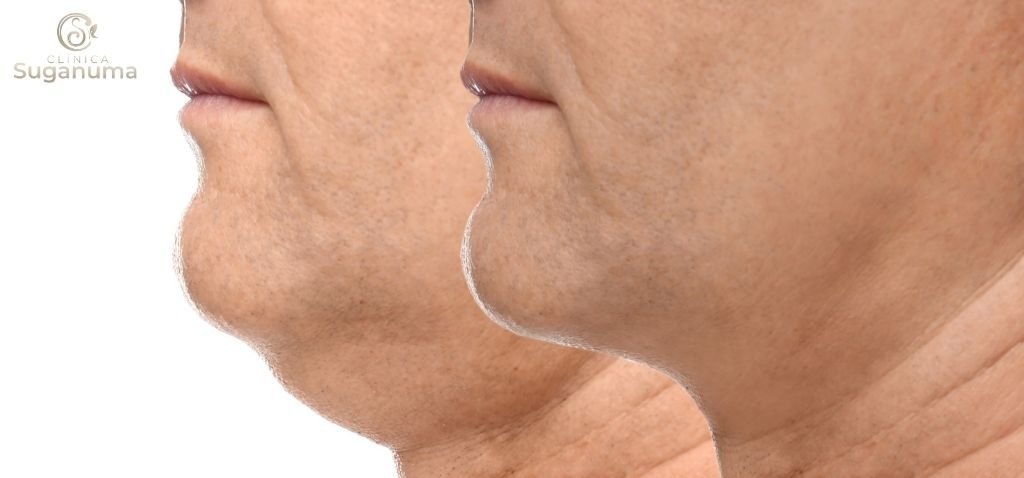 Existem-tratamentos-caseiros-para-a-flacidez-da-papada