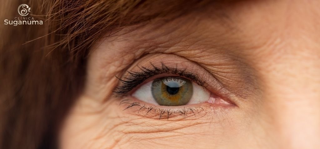 Existem-tratamentos-caseiros-para-as-rugas-dos-pes-de-galinha