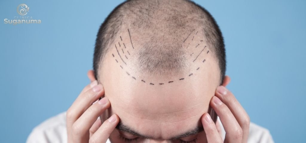 Ha-alguma-maneira-de-prevenir-a-entrada-nos-cabelos