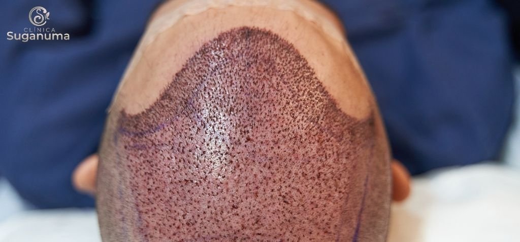 Existem-riscos-e-efeitos-colaterais-associados-ao-transplante-capilar