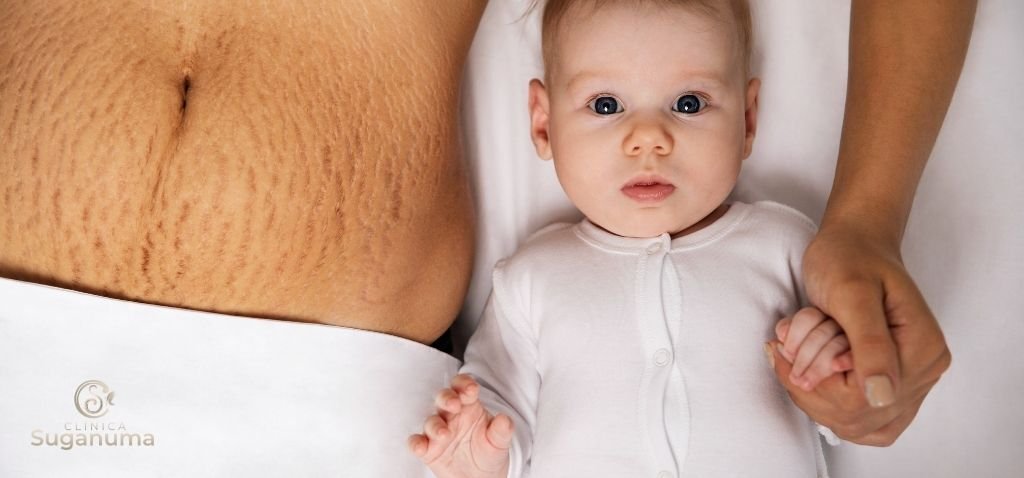 Qual-e-a-causa-das-estrias-vermelhas