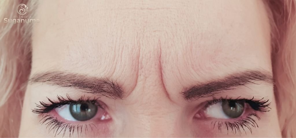 Existem-tratamentos-caseiros-para-as-rugas-do-bravo