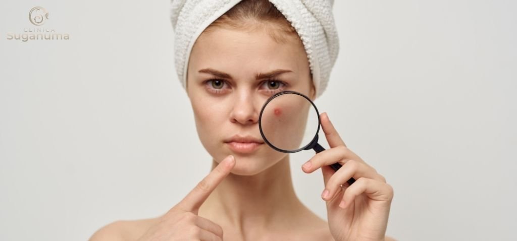 Qual-e-a-causa-da-acne