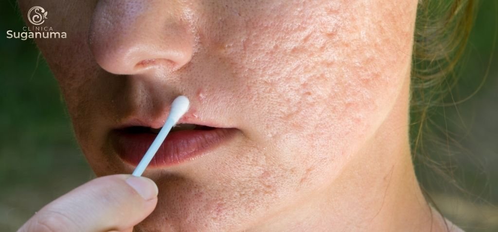 Qual-e-a-causa-das-cicatrizes-de-acne